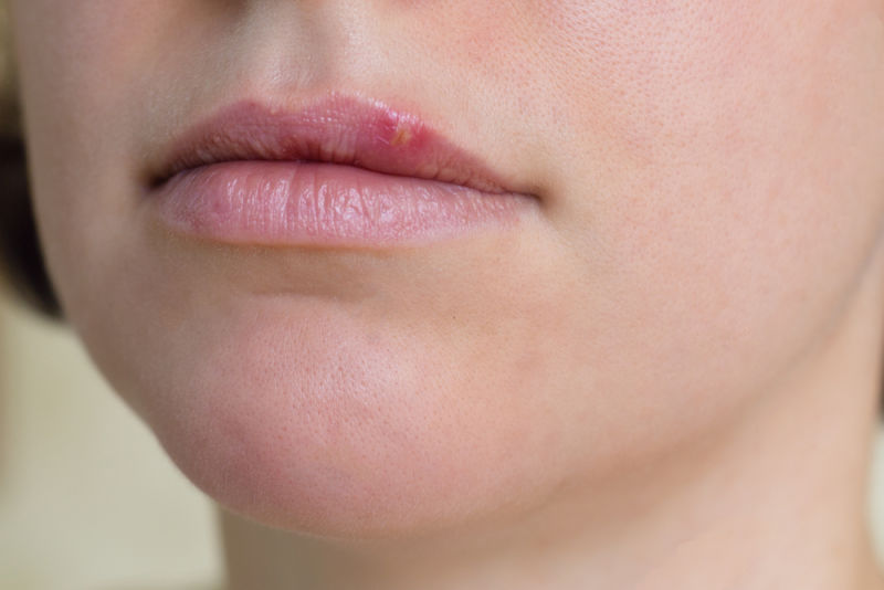 Cara Mencegah Penyakit Herpes Minyak kutus kutus
